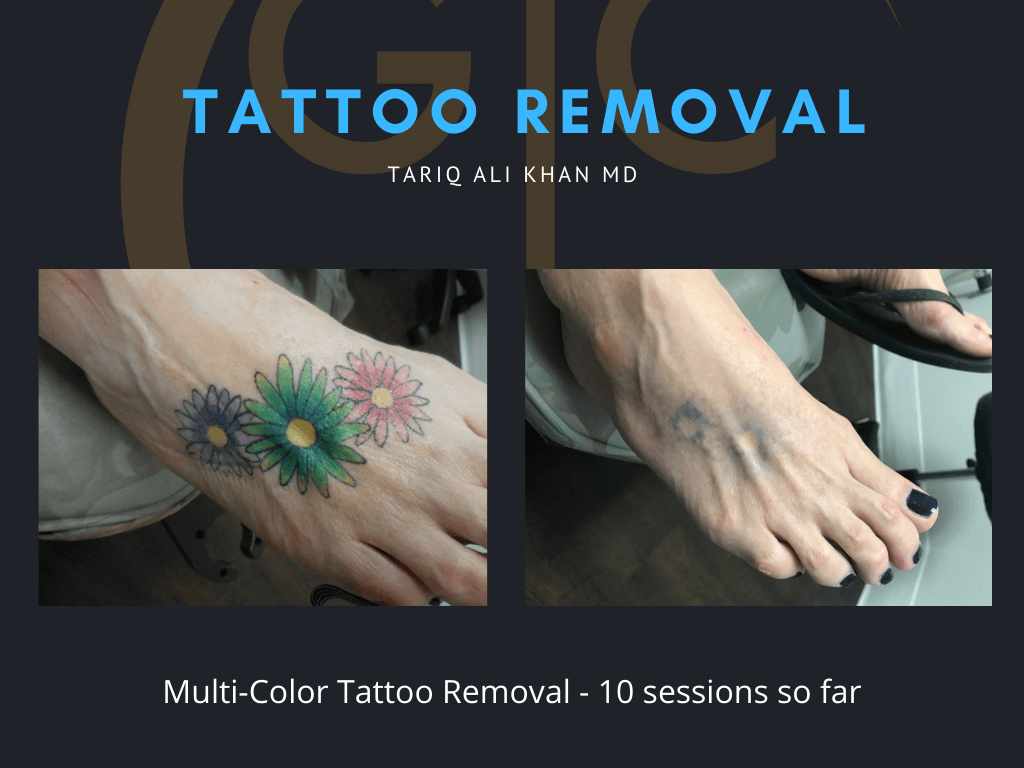 Gentle Care Laser Tustin & Long Beach Before and After picture - Tattoo Removal